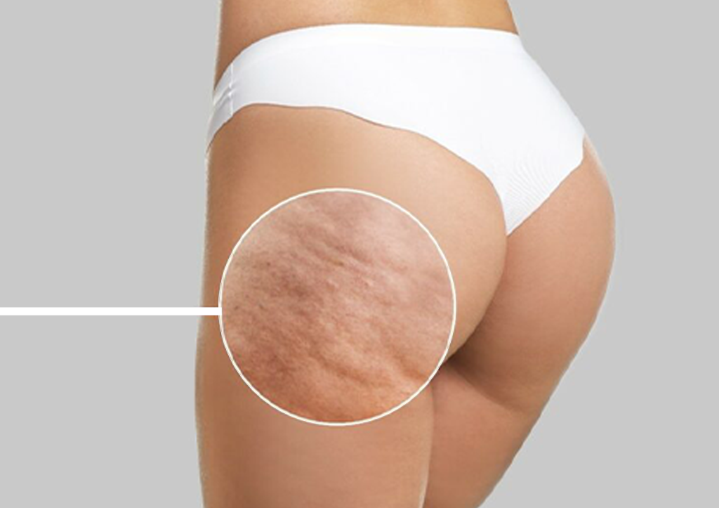 INESTETISMI CORPO: NUOVE SCOPERTE E SOLUZIONI