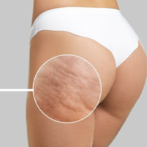 INESTETISMI CORPO: NUOVE SCOPERTE E SOLUZIONI